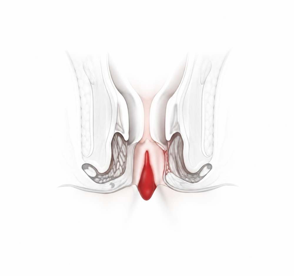 hemoroid-basur-bursa